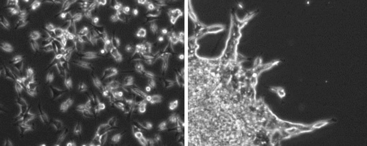 Cancer cell invasion